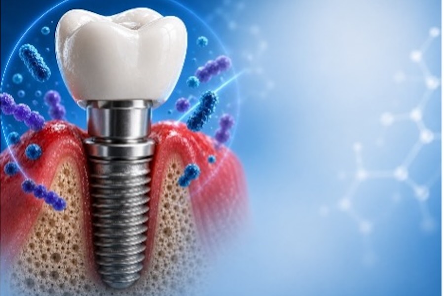 monitoraggio-peri-implantare